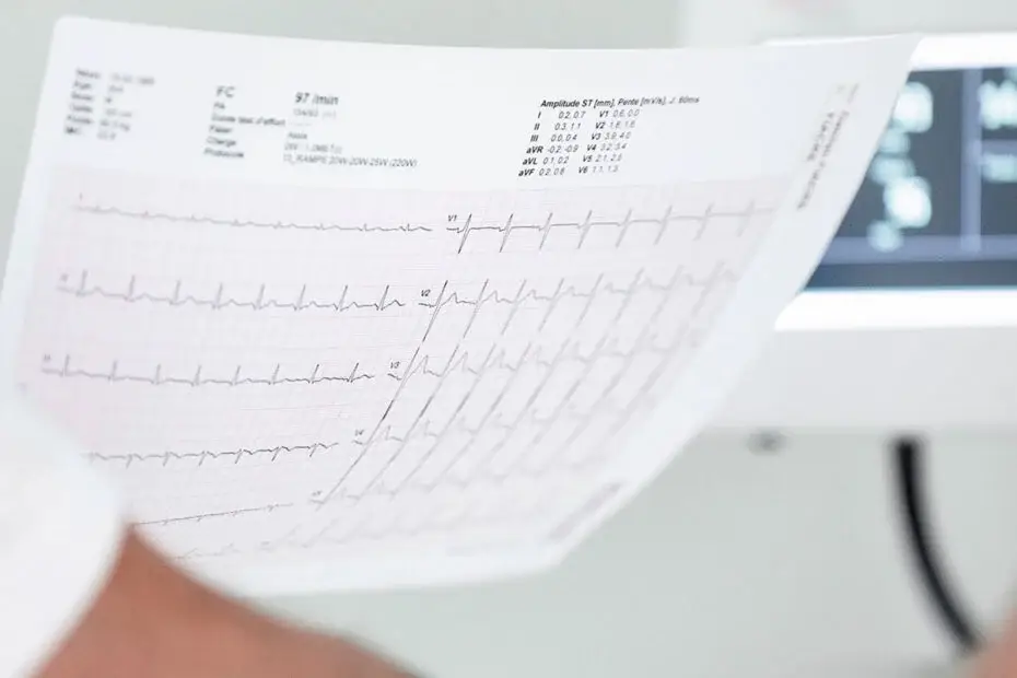 Électrocardiogramme (ECG) montrant l'activité cardiaque, utilisé pour détecter les anomalies cardiaques, dans un contexte médical pour le suivi après un traitement cardiaque.