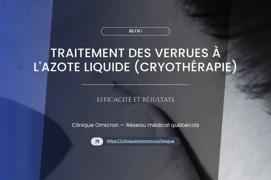 Wart treatment with liquid nitrogen (cryotherapy) by Clinique Omicron, effectiveness and results, medical blog.