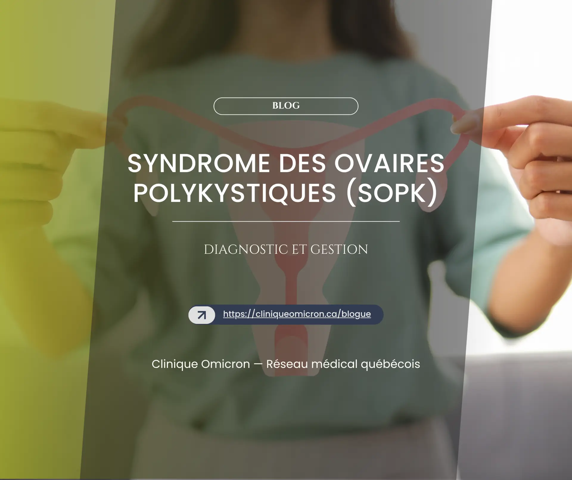 Personne tenant un graphique repr&eacute;sentant le syst&egrave;me reproducteur f&eacute;minin, illustrant le syndrome des ovaires polykystiques (SOPK) pour le blog de la Clinique Omicron.