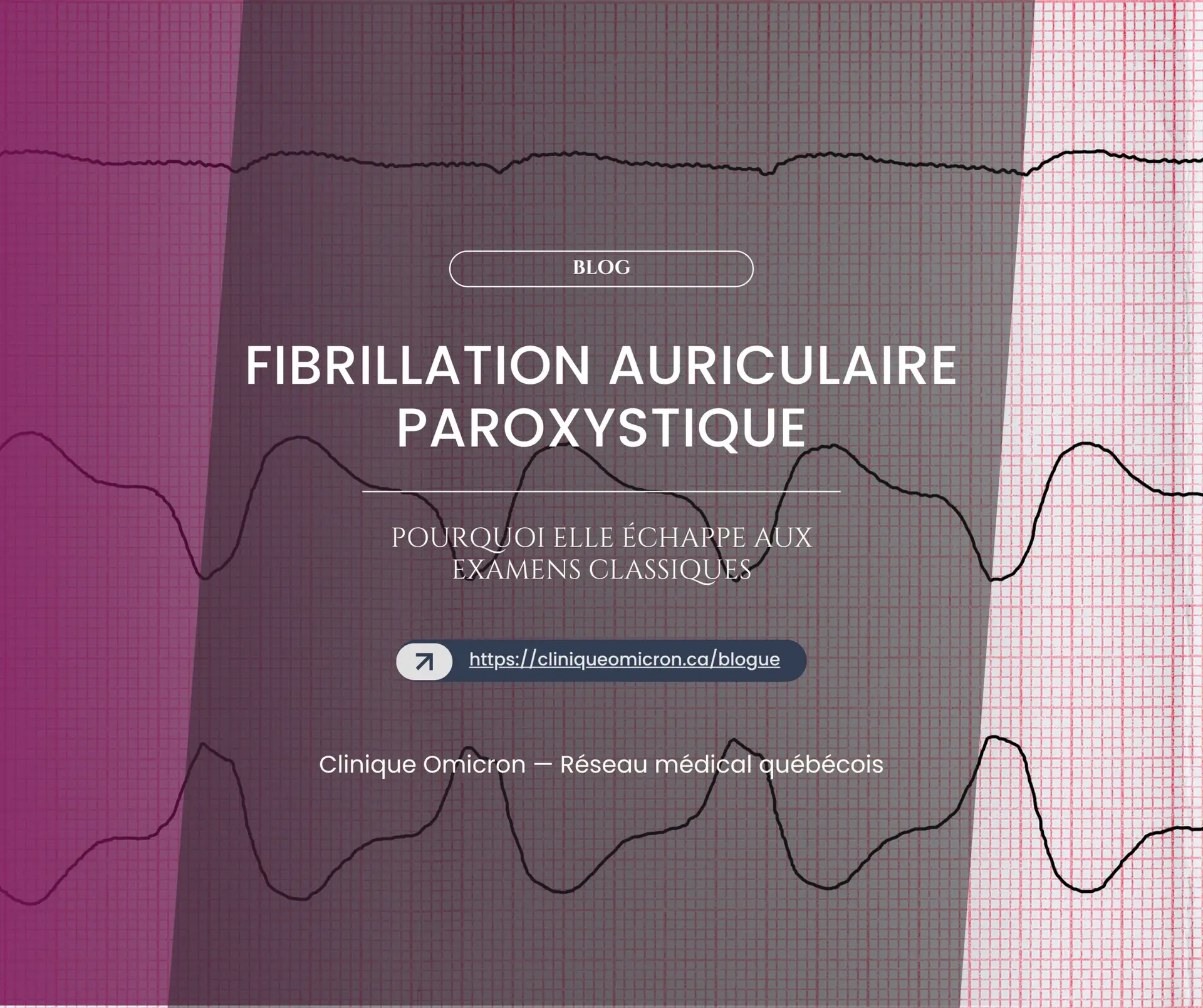 Fibrillation auriculaire paroxystique : pourquoi elle &eacute;chappe aux examens classiques