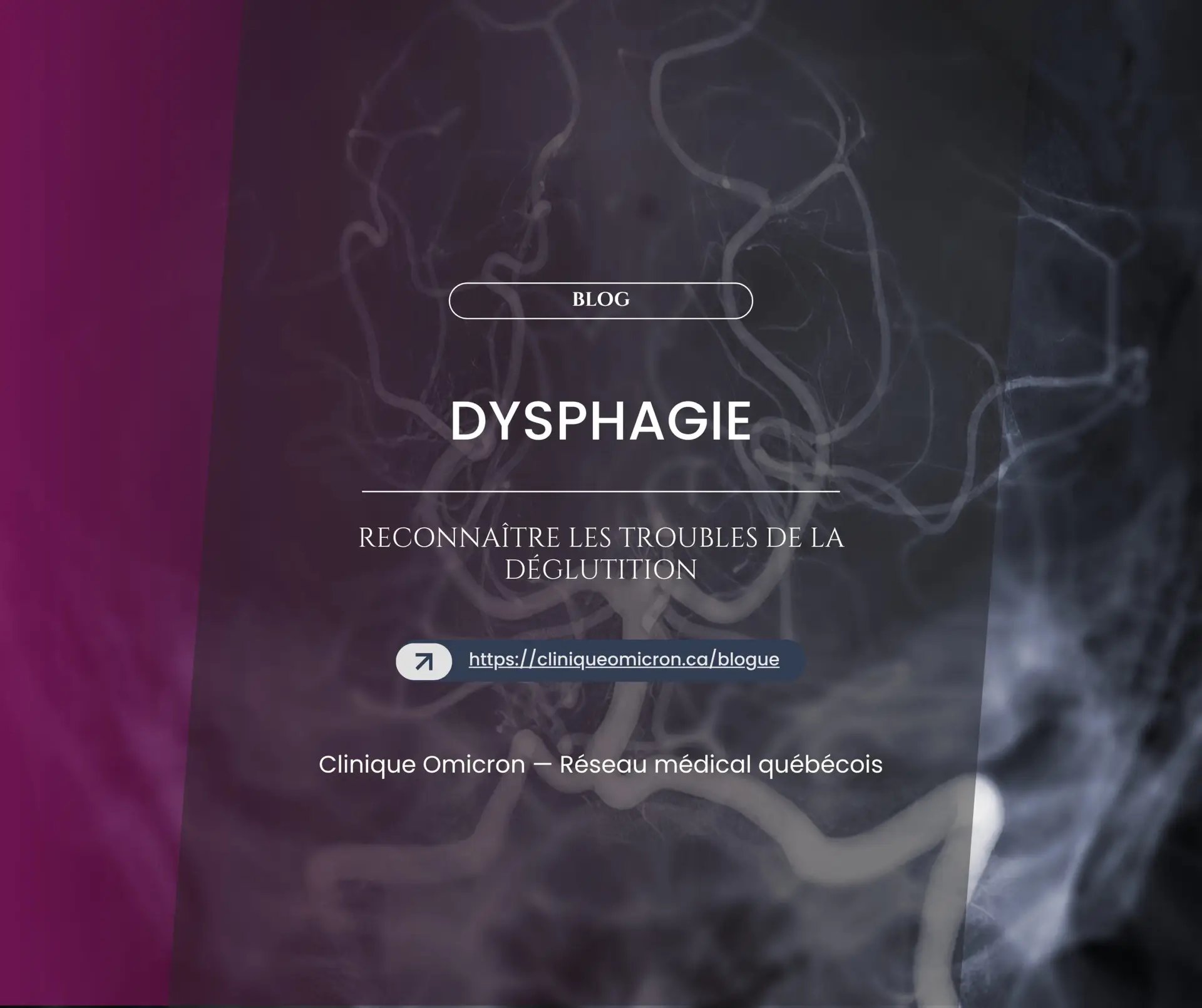 Dysphagie : reconnaître les troubles de la déglutition